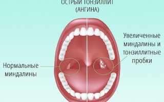 Диагностика и лечение гнойного тонзиллита