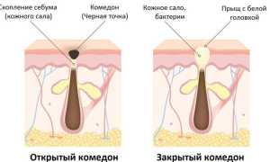 Проблемная кожа: почему появляются чёрные точки и как это предотвратить
