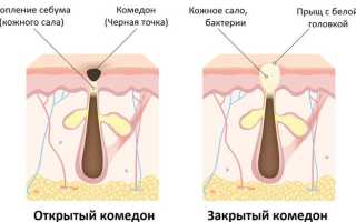 Проблемная кожа: почему появляются чёрные точки и как это предотвратить