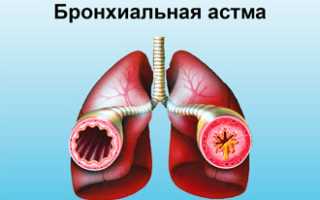 Трахеит у взрослых
