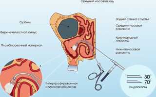 Как делается прокол при гайморите?