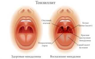 Причины возникновения тонзилитных пробок