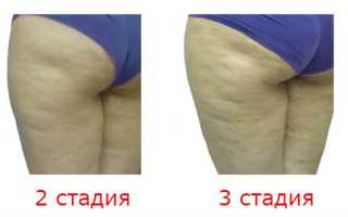 Целлюлит: когда нужно медикаментозное лечение?