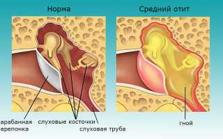 Можно ли греть нос солью при гайморите?