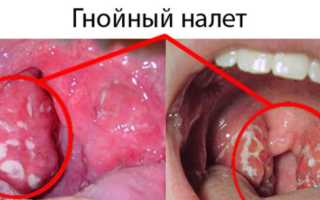 Как лечить ангину по доктору Комаровскому