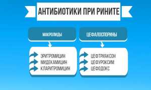 Лечение гнойного ринита