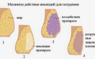 Эффективны ли инъекции в борьбе с целлюлитом