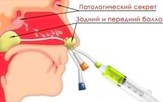 Ямик процедура для лечения гайморита