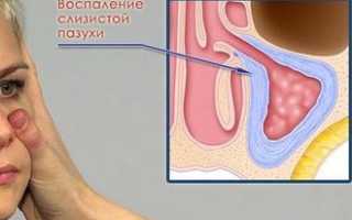 Прием антибиотиков при ангине