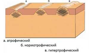 Почему не загорают шрамы на теле