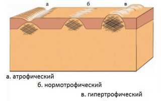 Почему не загорают шрамы на теле