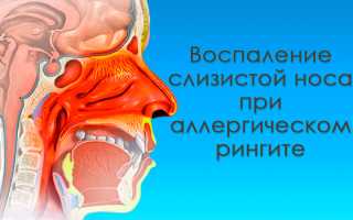 Как вылечить ринит с помощью народных средств