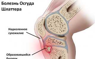 Рентген коленного сустава – что показывает снимок?