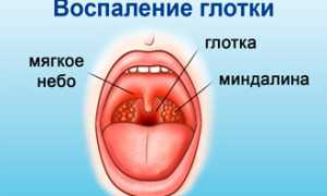 Лечение бактериального фарингита