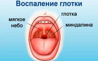 Лечение бактериального фарингита