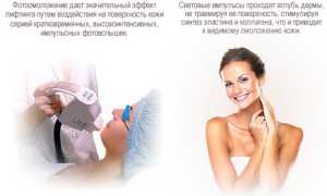 Фотоомоложение: особенности и преимущества метода