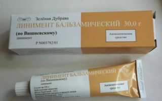 Турунды при гайморите