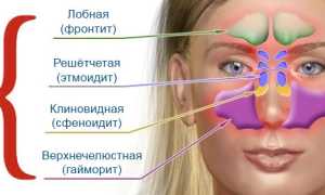 Чем отличается синусит от гайморита