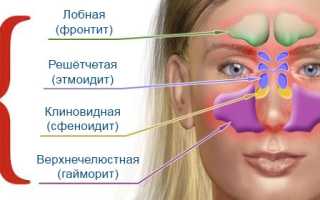 Чем отличается синусит от гайморита