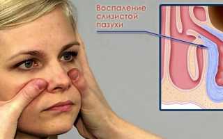 Как правильно лечить хронический риносинусит