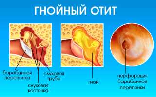 Полезные советы при проведении ингаляции от ринита