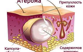 Атерома за ухом