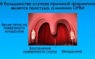 Чем лечить фарингит у детей?