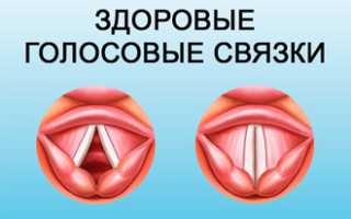 Лечение пареза гортани