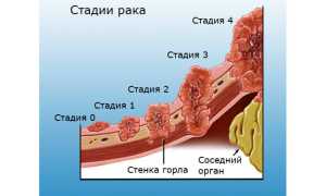 Онкология горла