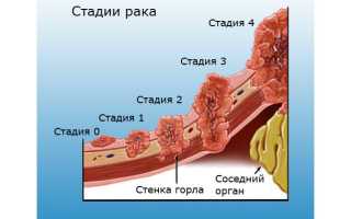 Онкология горла