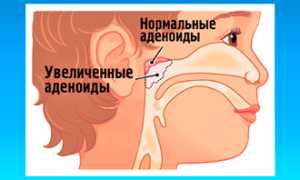 Почему у детей по ночам заложен нос