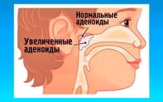 Почему у детей по ночам заложен нос