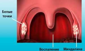 Как хронический фарингит влияет на слух