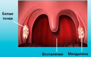 Как хронический фарингит влияет на слух