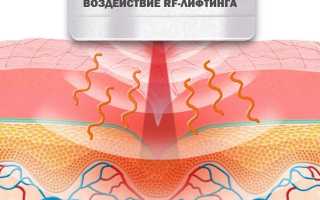 Радиочастотный лифтинг: виды, показания, результат