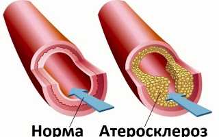 Носовое кровотечение и все его особенности