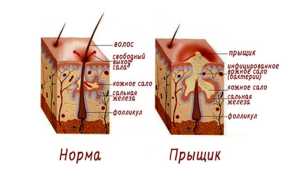 Прыщи на мочках ушей