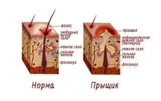 Прыщи на мочках ушей