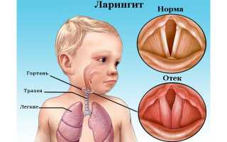 Лечение ларингита у ребенка