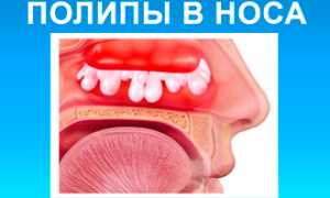 Причины постоянного ринита