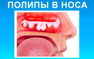 Причины постоянного ринита