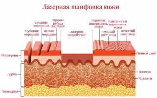 Лазерная шлифовка: особенности процедуры и показания к проведению