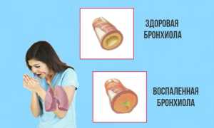 Как и чем лечить осиплость голоса