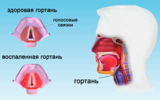 Признаки ларингита у взрослых