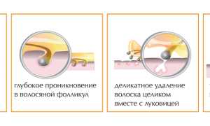 Депиляция подмышек сахарной пастой: правила проведения