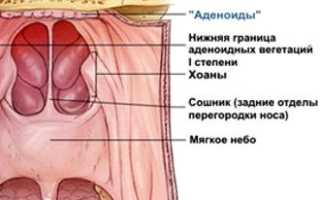 Острый аденоидит у ребенка: его симптомы и лечение