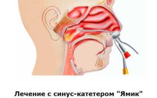 Дышит ли нос при гайморите