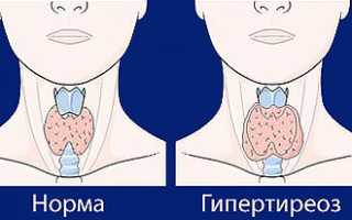 Народные средства от першения в горле