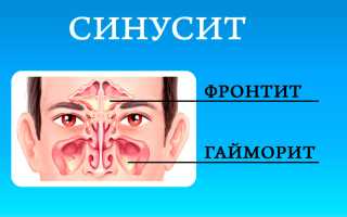 Ринит, который не проходит больше 2 недель