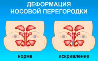 Лучшие способы лечения сухого ринита